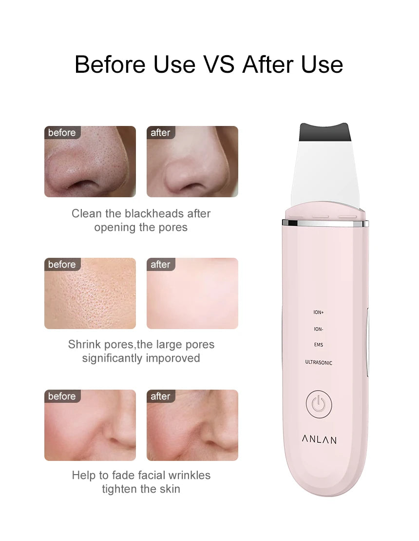 Ultrasonic Skin Scrubber Deep Cleaning Peeling Shovel Limpiador Facial Skin Care Face Lifting Machine